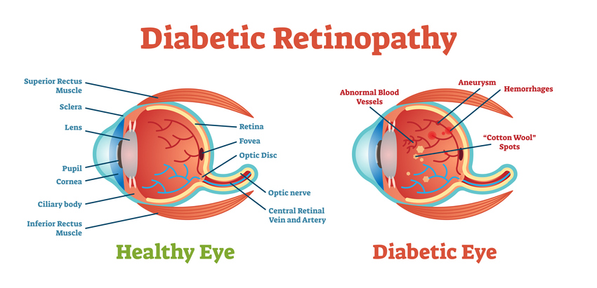 Diabetic Retinopathy vector illustration diagram, diabetic eye exam Western MA, diabetic eye exam Springfield MA, diabetic eye exam East Longmeadow MA