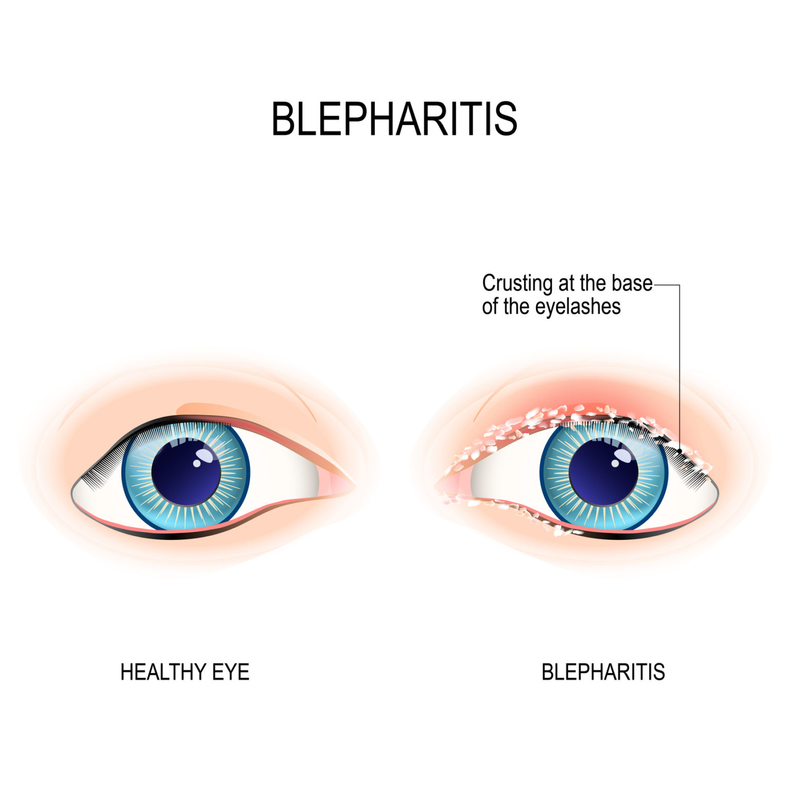 What Is Blepharitis Henderson Eye Care 