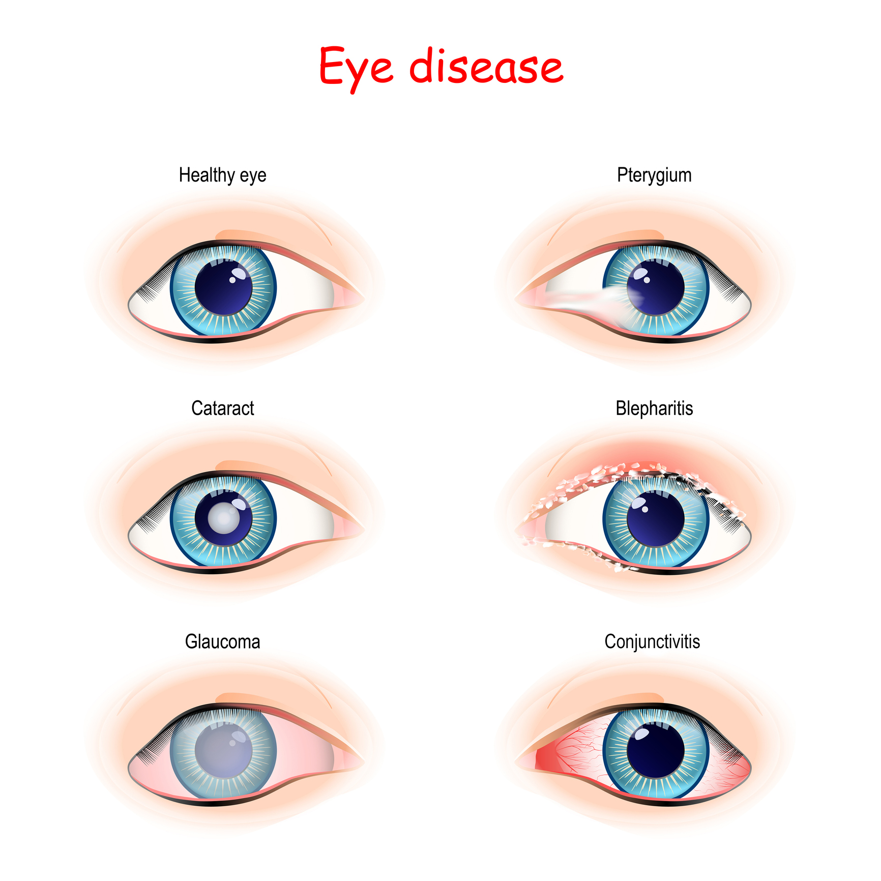 Глаза сравнение. Птеригиум классификация. Сравни на глаз. Заболевания глаз птеригиум.