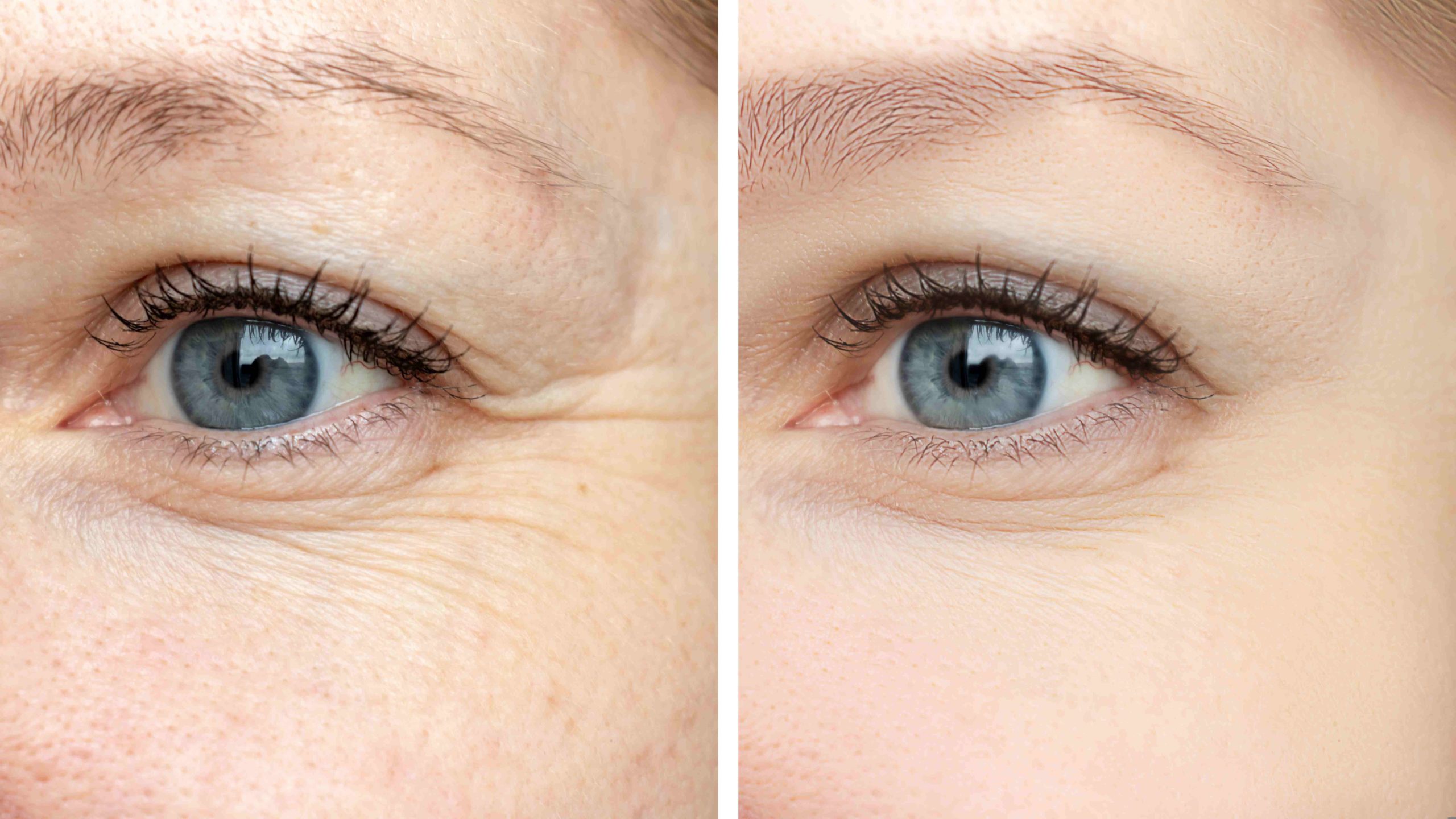 “Botox Under Eyes: Before and After Transformation” - BeautyKylie