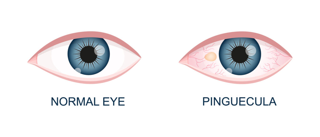 Eye healthy and with pinguecula. Conjunctival degeneration before and after surgery. Eye disease. Human organ of vision with pathology. Vector realistic illustration.