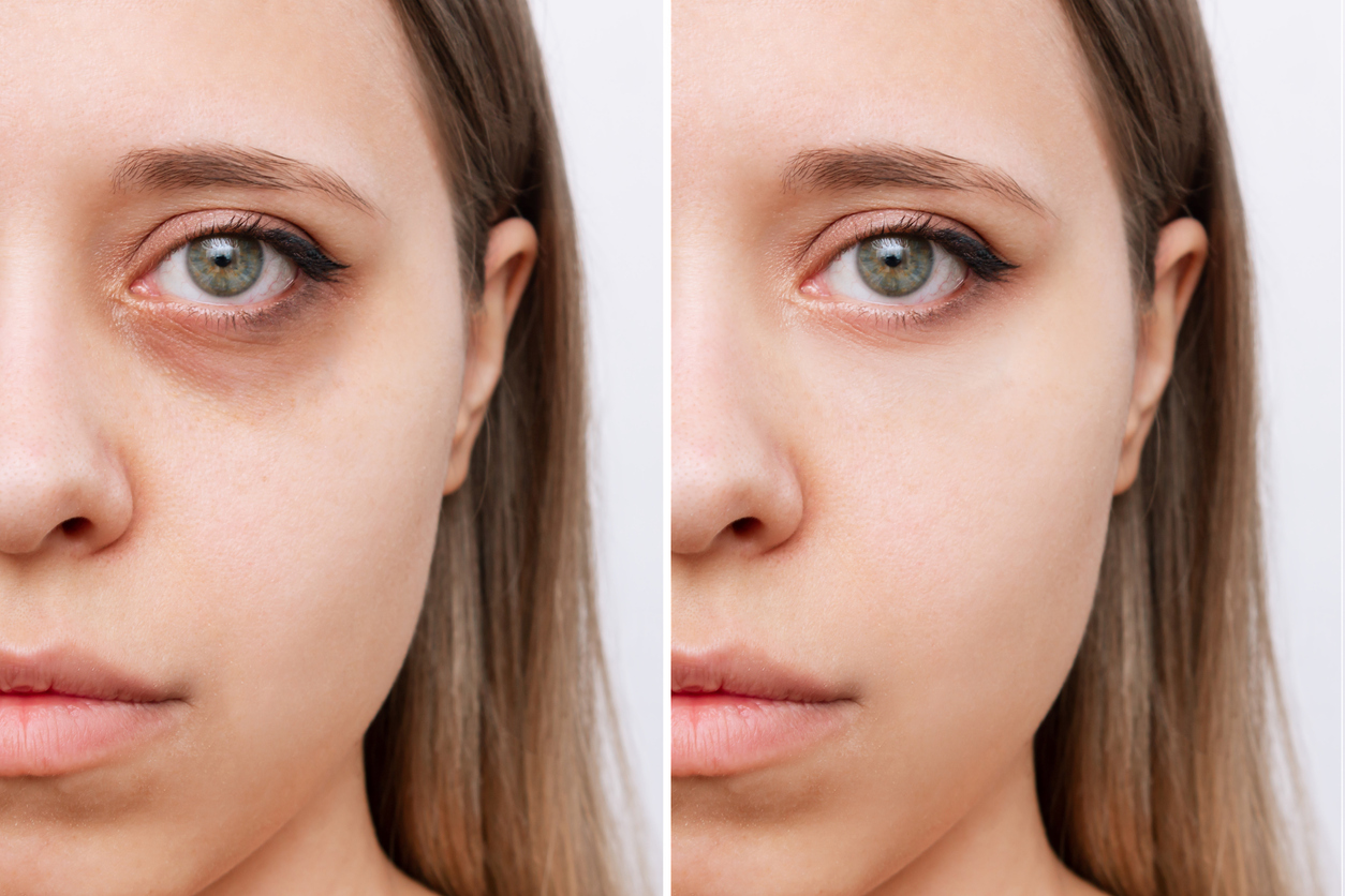 Young woman face with dark circles under eyes before and after cosmetic treatment, juvederm